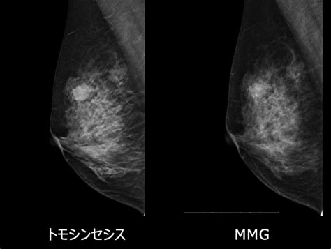 微細石灰化の集簇|マンモグラフィ検査で見られる石灰化病変について